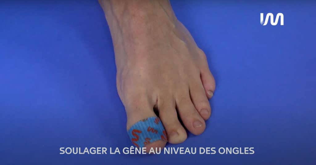 STIMCARE-TUTO-SOULAGER-LA-GENE-DES-ONGLES