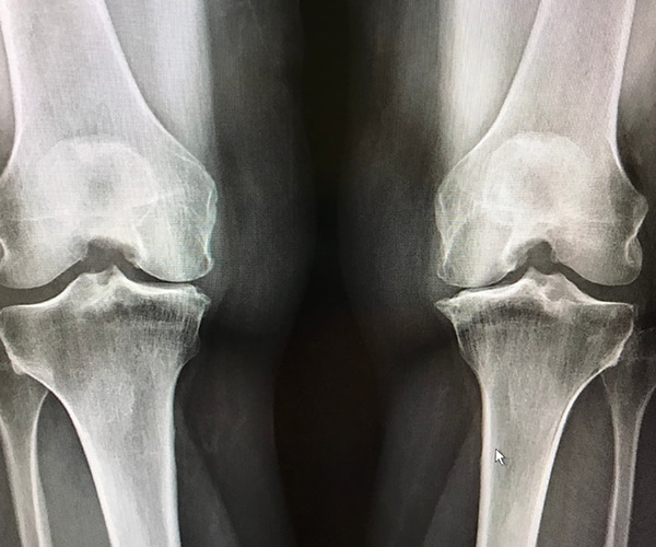 L'arthrose du Genou : symptômes et guérison - Pôle ReyActive Morestel
