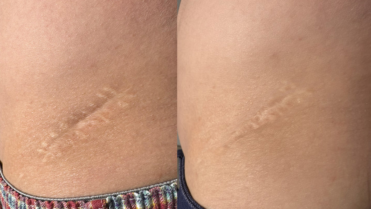 Patch STIMCARE sur cicatrice